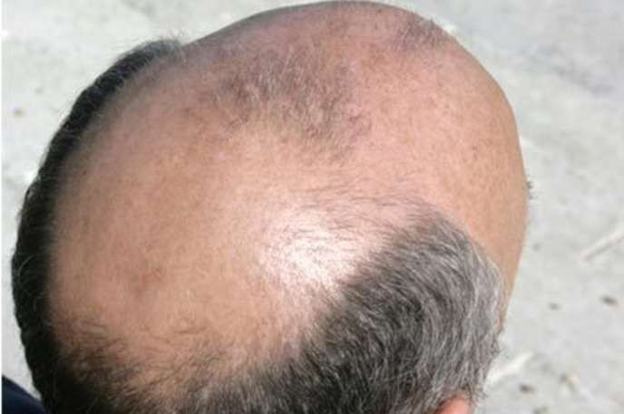 A Cure to Baldness?