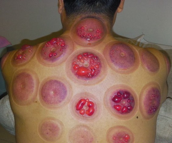 Cupping Therapy