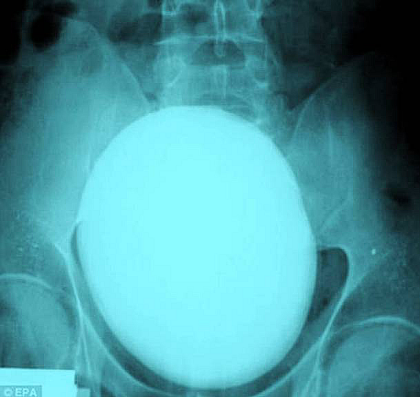 A large kidney stone