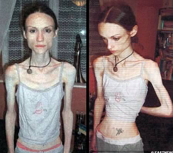 10 Most Shocking Cases Of Anorexia Quizai